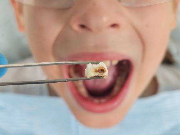 Best Emergency Root Canal Therapy in Wellsville, KS